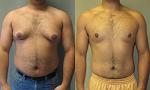     
: GynecomastiaFrontalAsymSevere.jpg
: 25
:	54.4 
ID:	11573180