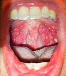     
: Gerpeticheskaya_angina_2.jpg
: 26
:	37.0 
ID:	12339826