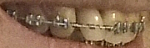     
: tooth2.png
: 17
:	59.0 
ID:	12900761
