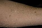     
: epidermodysplasia-verruciformis-3-foto.jpg
: 60
:	15.6 
ID:	4875701