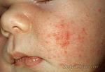     
: baby-acne.jpg
: 27
:	63.2 
ID:	9223076